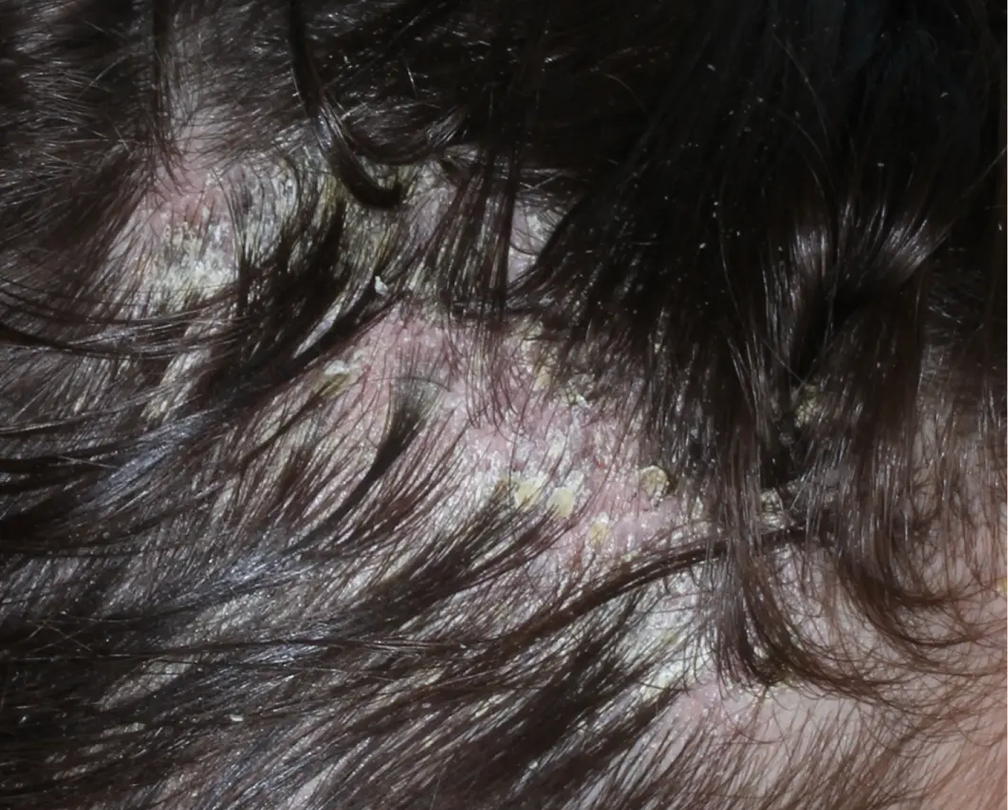 Image of scalp at baseline