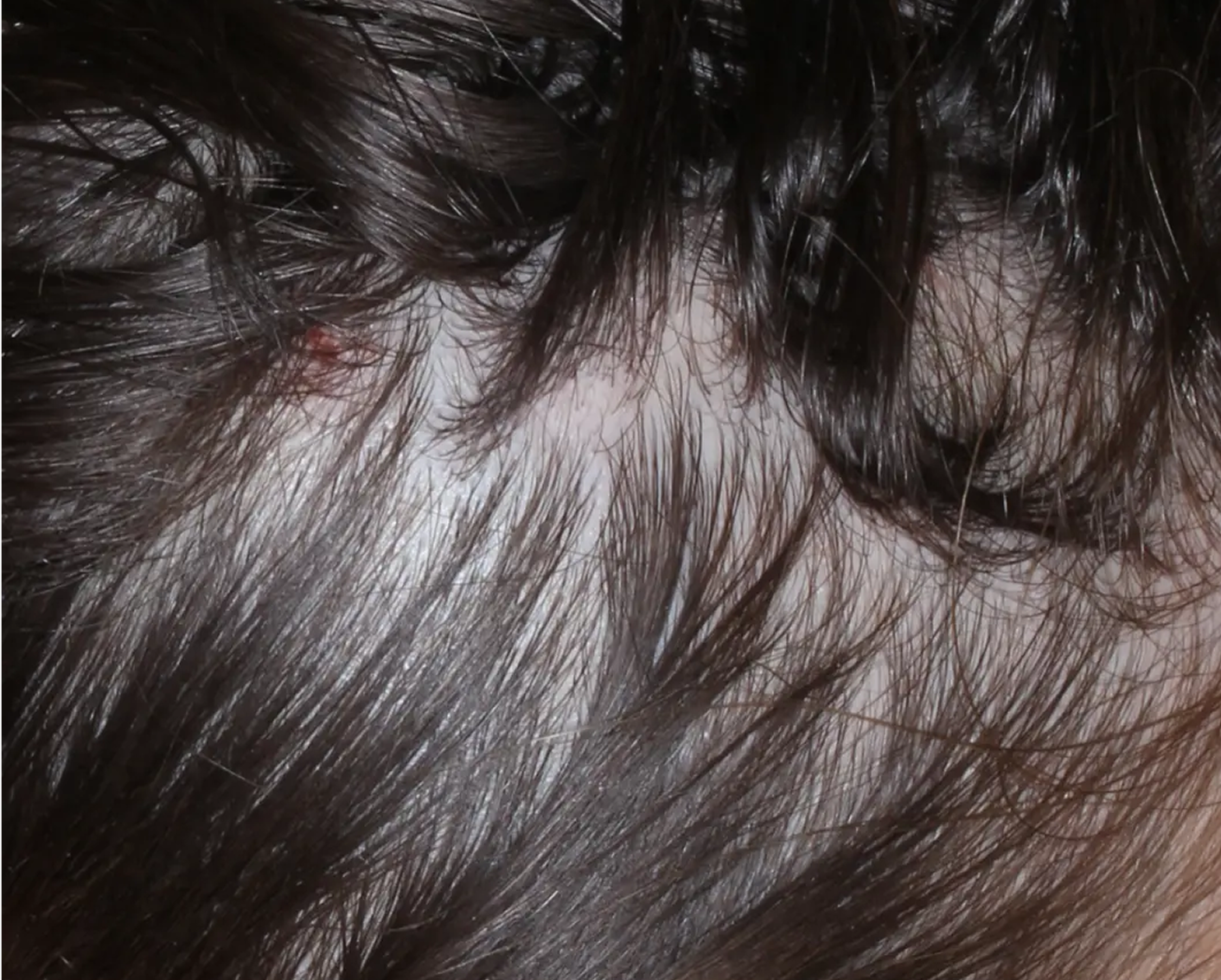 Image of scalp at week 2