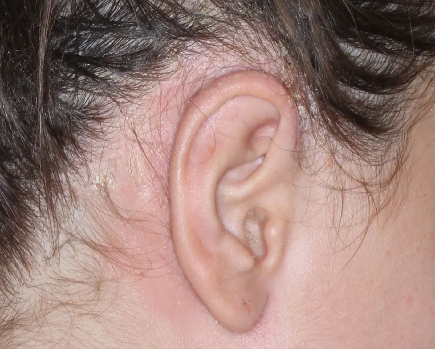 Image of ear at baseline