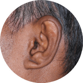 Ear with Seborrheic Dermatitis from an actual trial patient