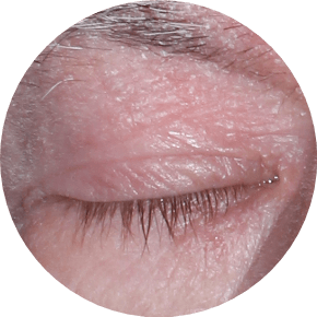 Closed eyelid with Seborrheic Dermatitis from an actual trial patient