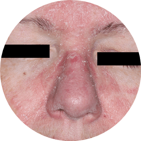 Face with Seborrheic Dermatitis from an actual trial patient