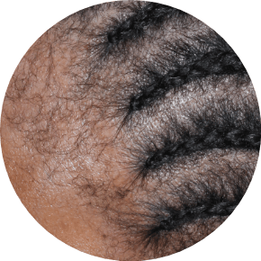Scalp of African American person with Seborrheic Dermatitis